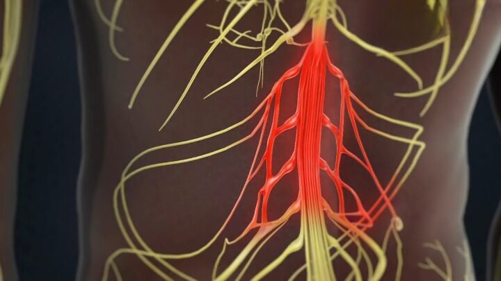 Diagnose Piriformis syndrome