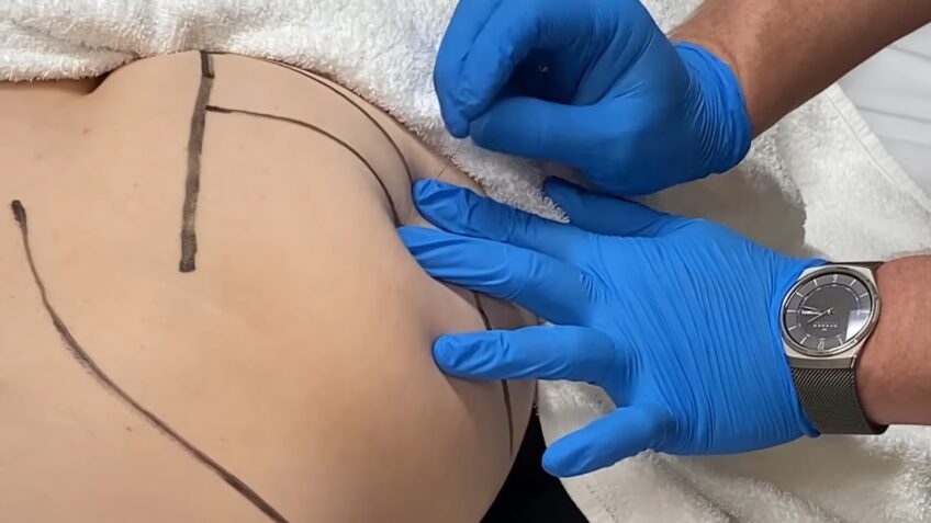 Dry Needling Piriformis