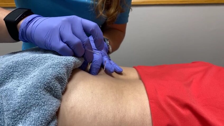 dry needling treatment