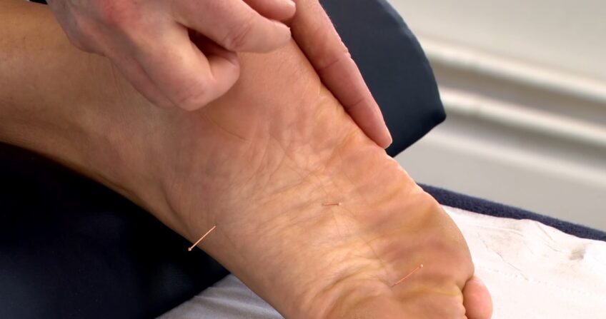 Dry Needling to the Foot