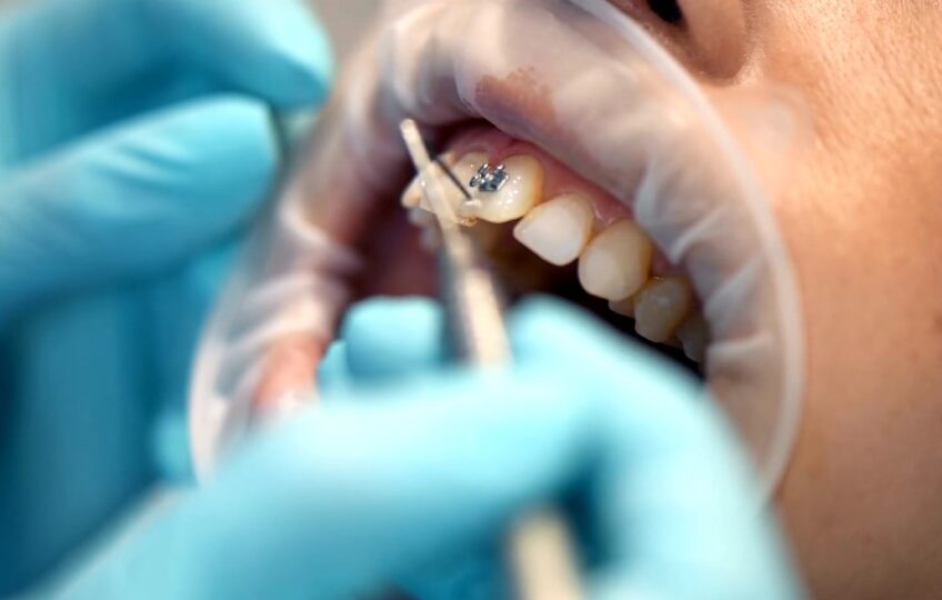How Much Will Cost to Remove Braces Without Insurance How You Can