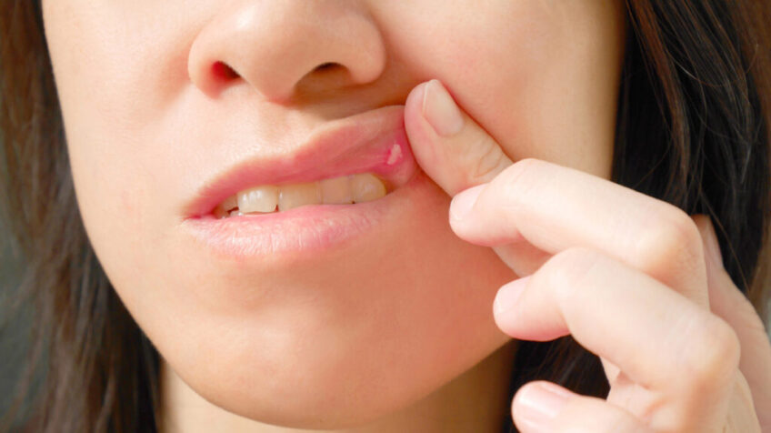 get-rid-of-lip-pimples-swollen-big-painful-upper-inside-around-your