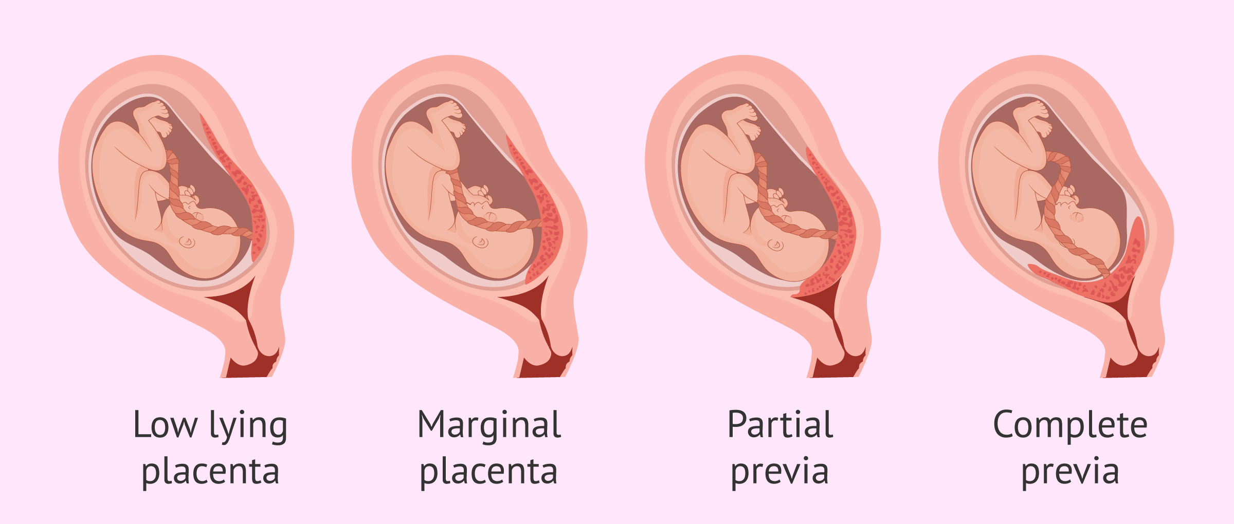 low lying placenta