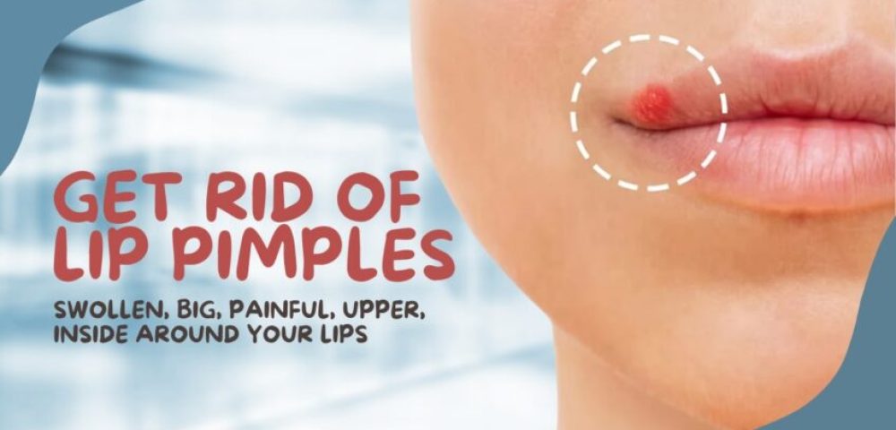 Get Rid of Lip Pimples