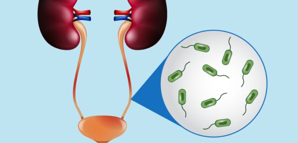 Urinary-tract-infection-UTI